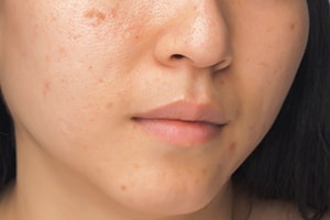 What causes acne and pimples