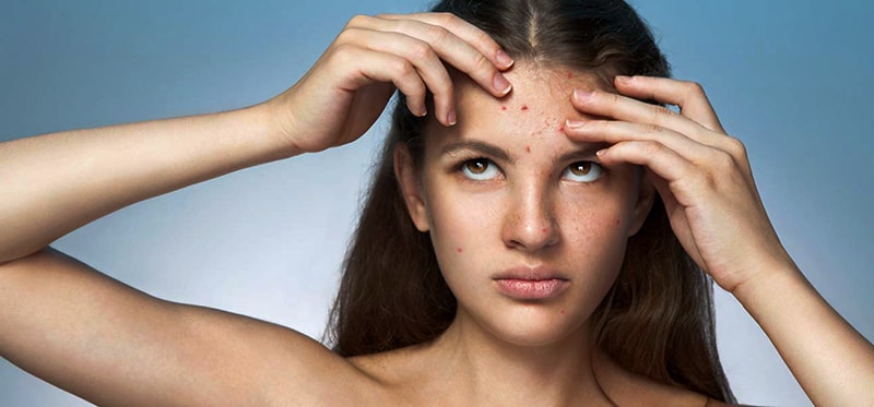 Why teenagers suffer from acne